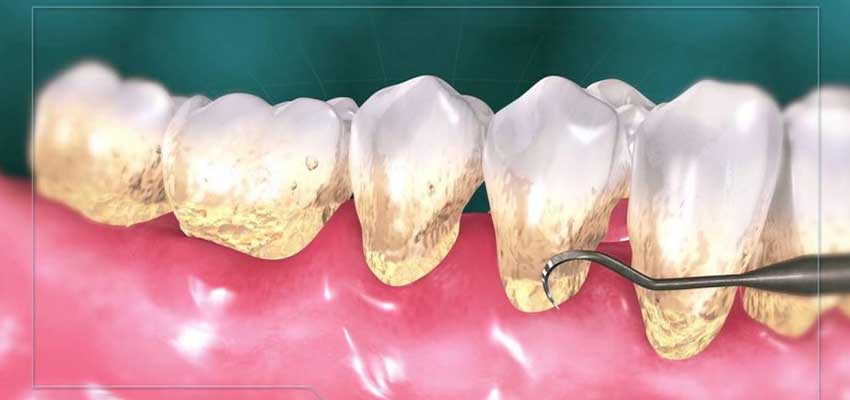 Tooth implant whitening