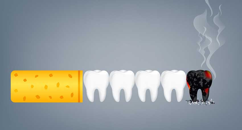 توصيات لزراعة الأسنان عند المدخنين